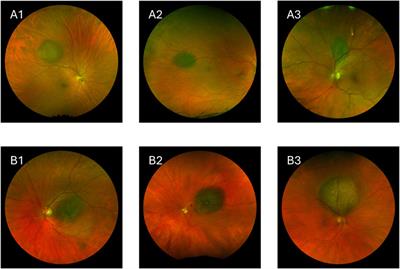 Artificial intelligence in the diagnosis of uveal melanoma: advances and applications